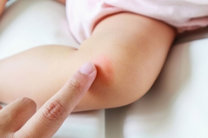 درمان حساسیت پوستی در کودکان